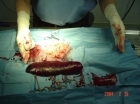 Enlarged spleen - Click to enlarge